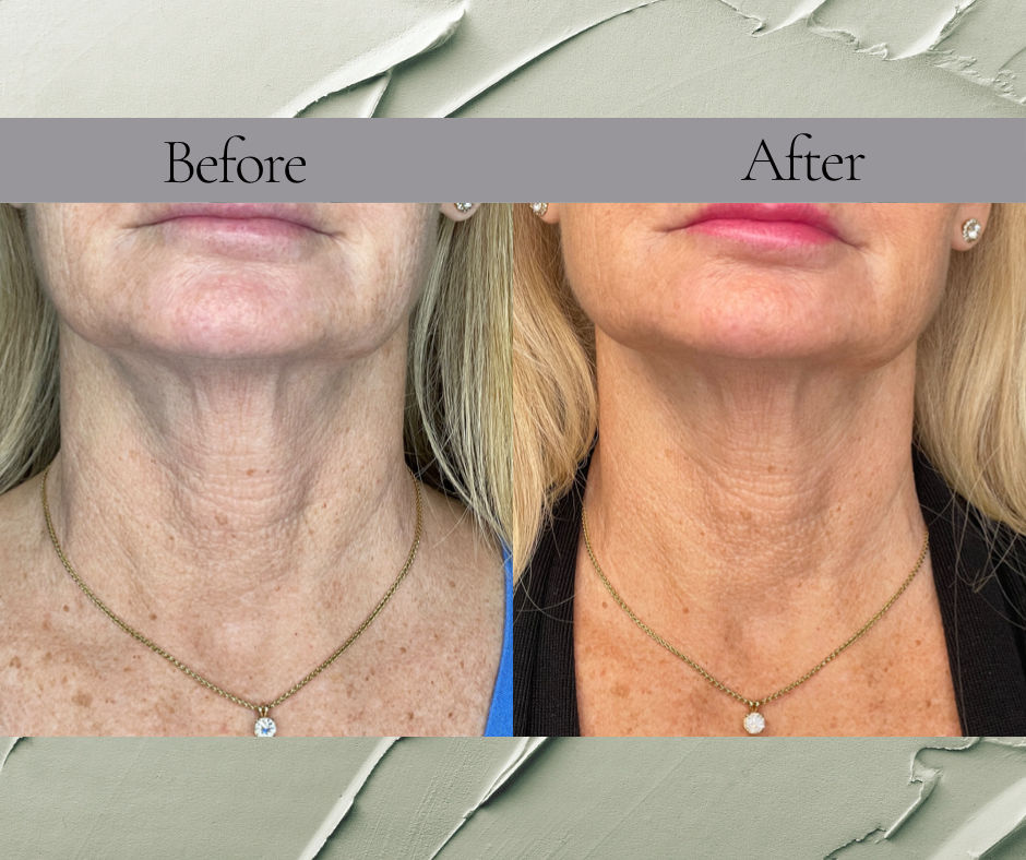 A before and after photo of a woman 's neck and face
