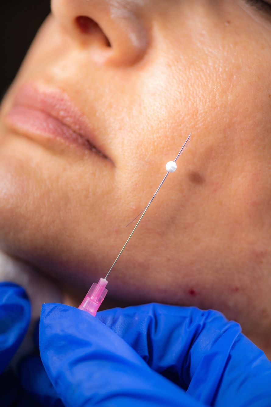 non surgical dermal filler treatments Oviedo, fl