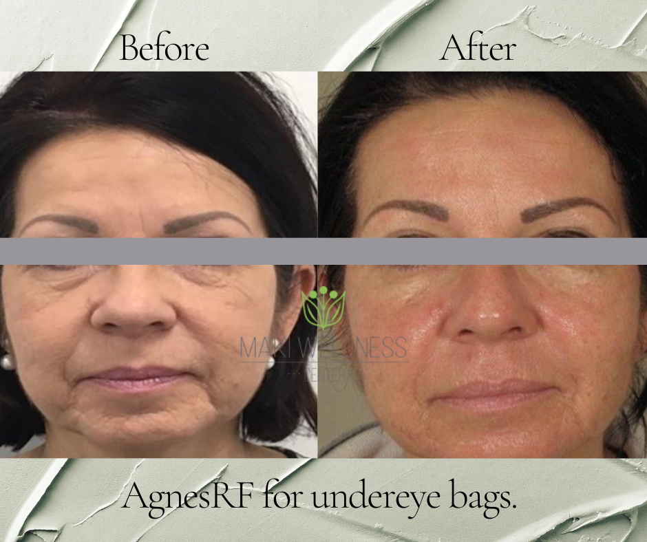 A before and after photo of a woman 's face