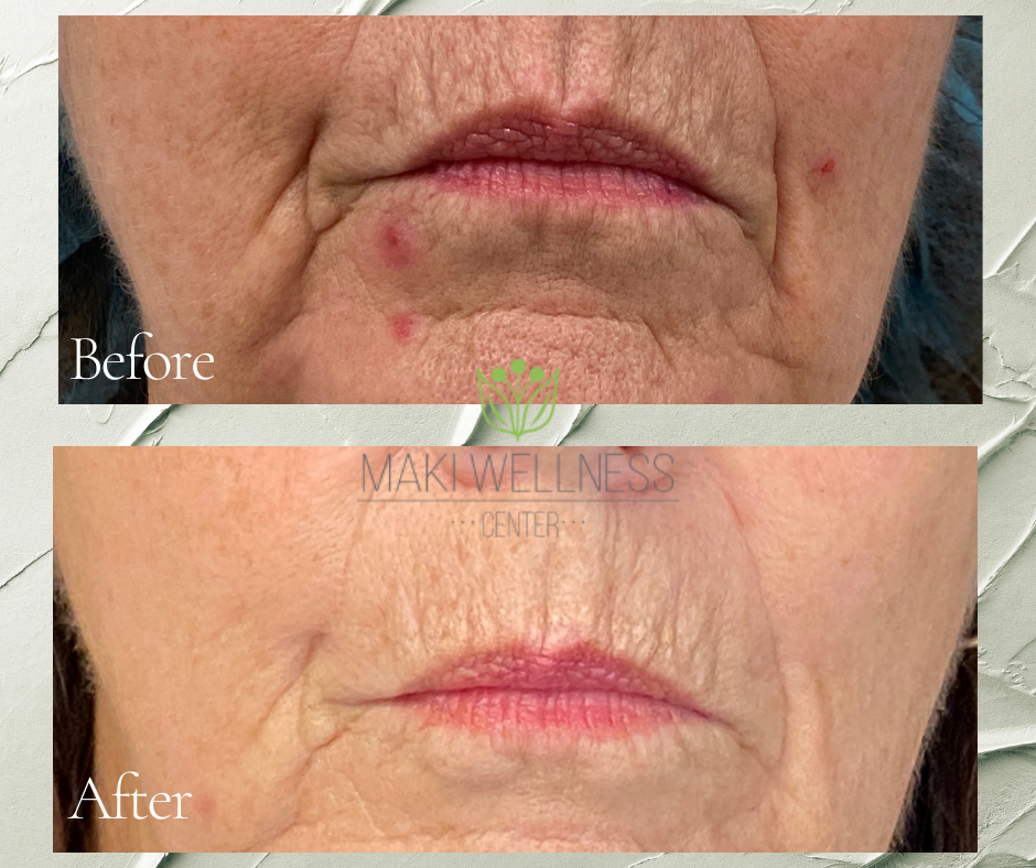 A before and after photo of a woman 's face