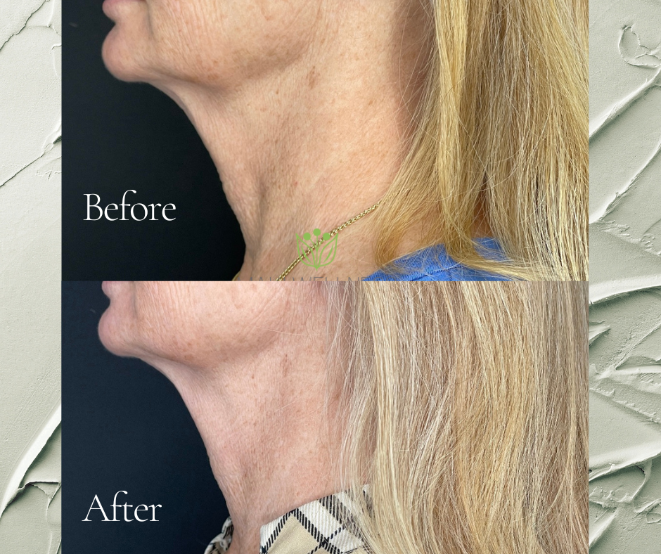 A woman 's neck is shown before and after a procedure