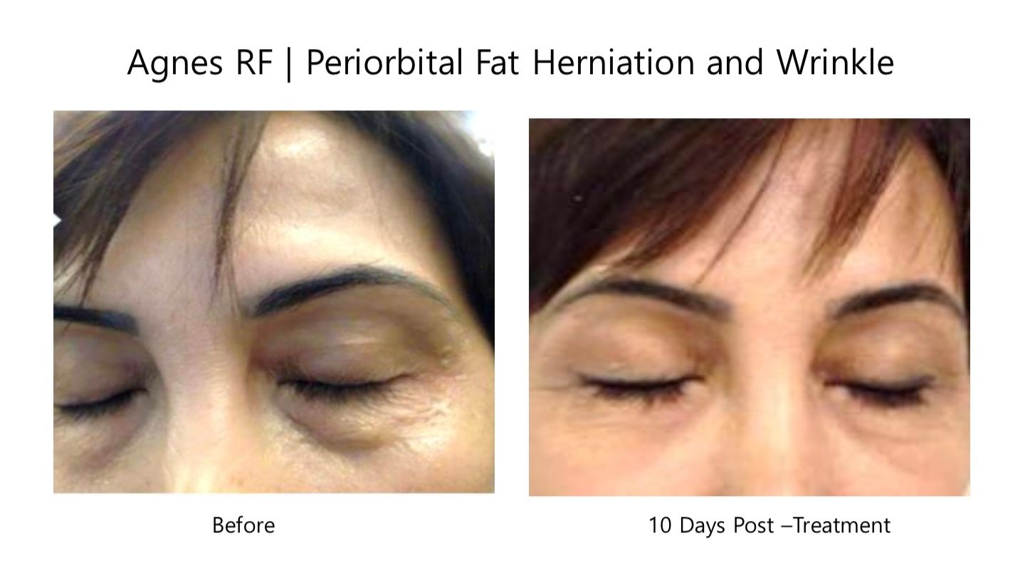 A before and after photo of a woman 's face with her eyes closed.