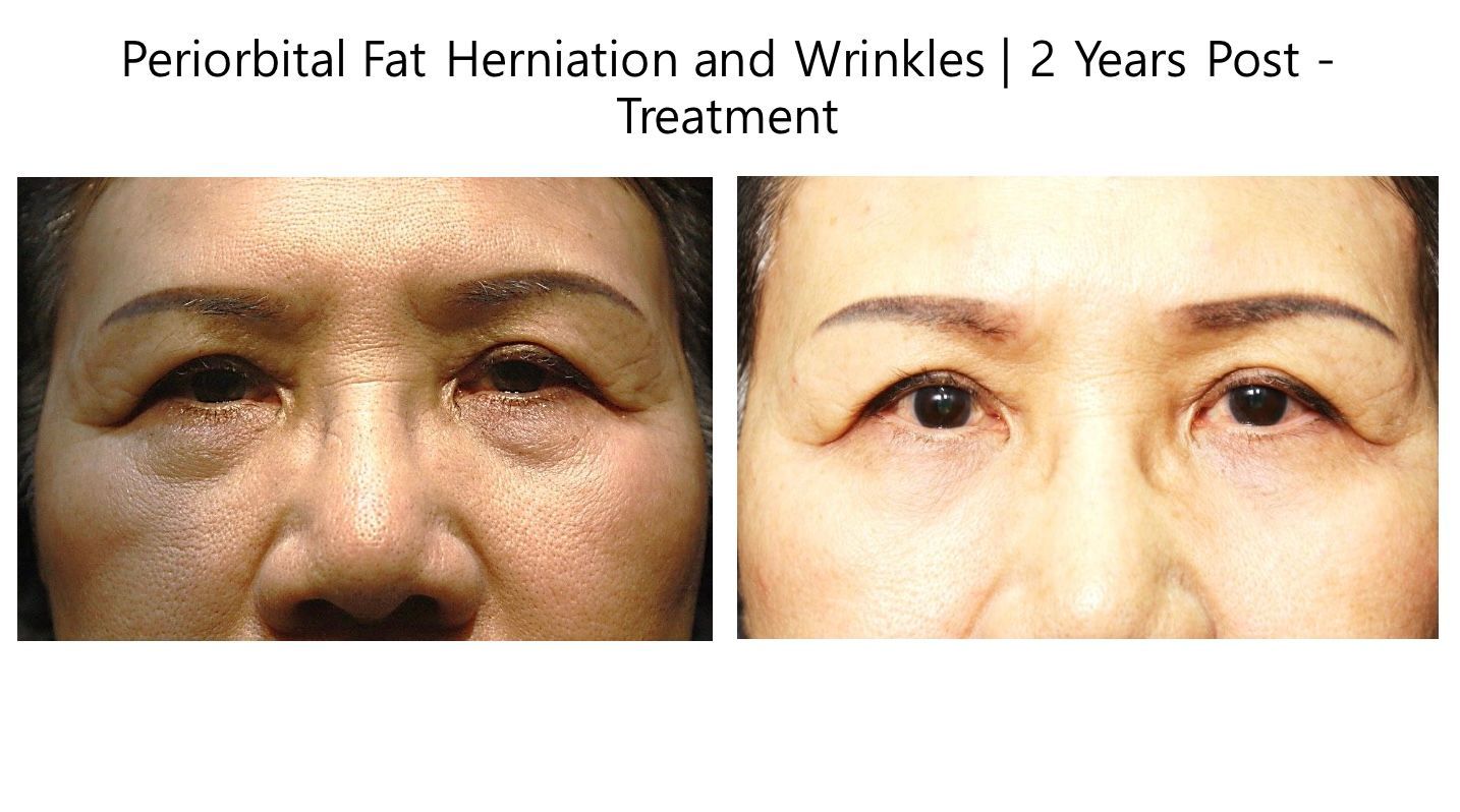 A before and after photo of a woman 's face with hernias and wrinkles.