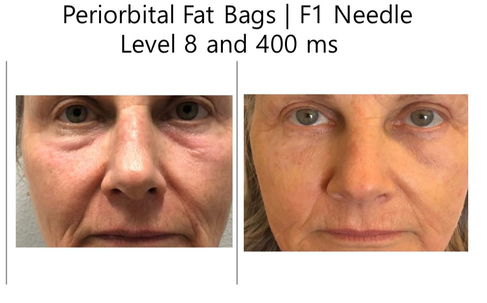 A before and after picture of a woman 's face