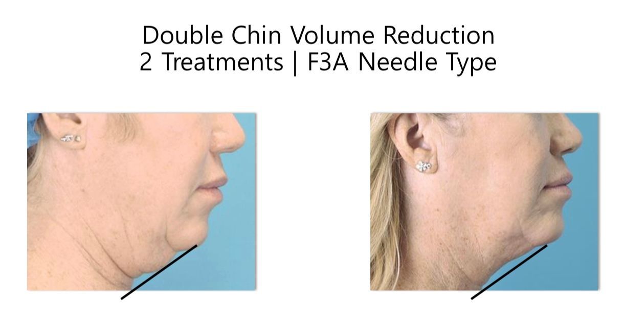 A before and after picture of a woman 's face with the words double chin volume reduction 2 treatments f3a needle type