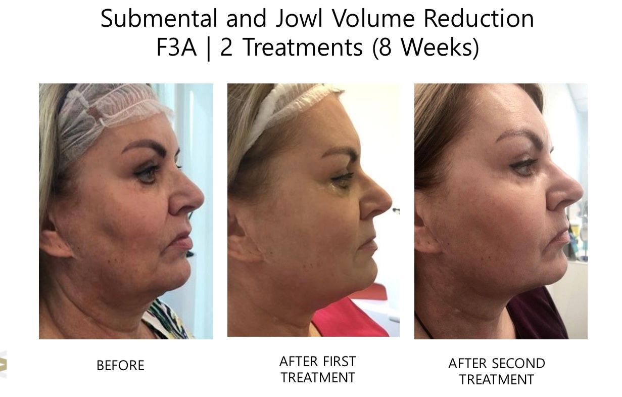 Three pictures of a woman 's face before and after treatments.