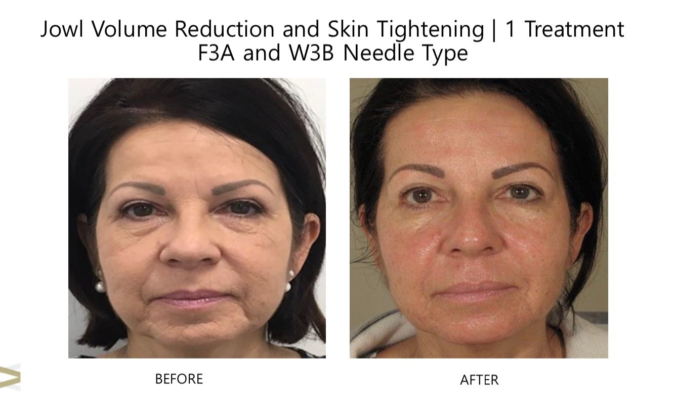 A before and after photo of a woman 's face.