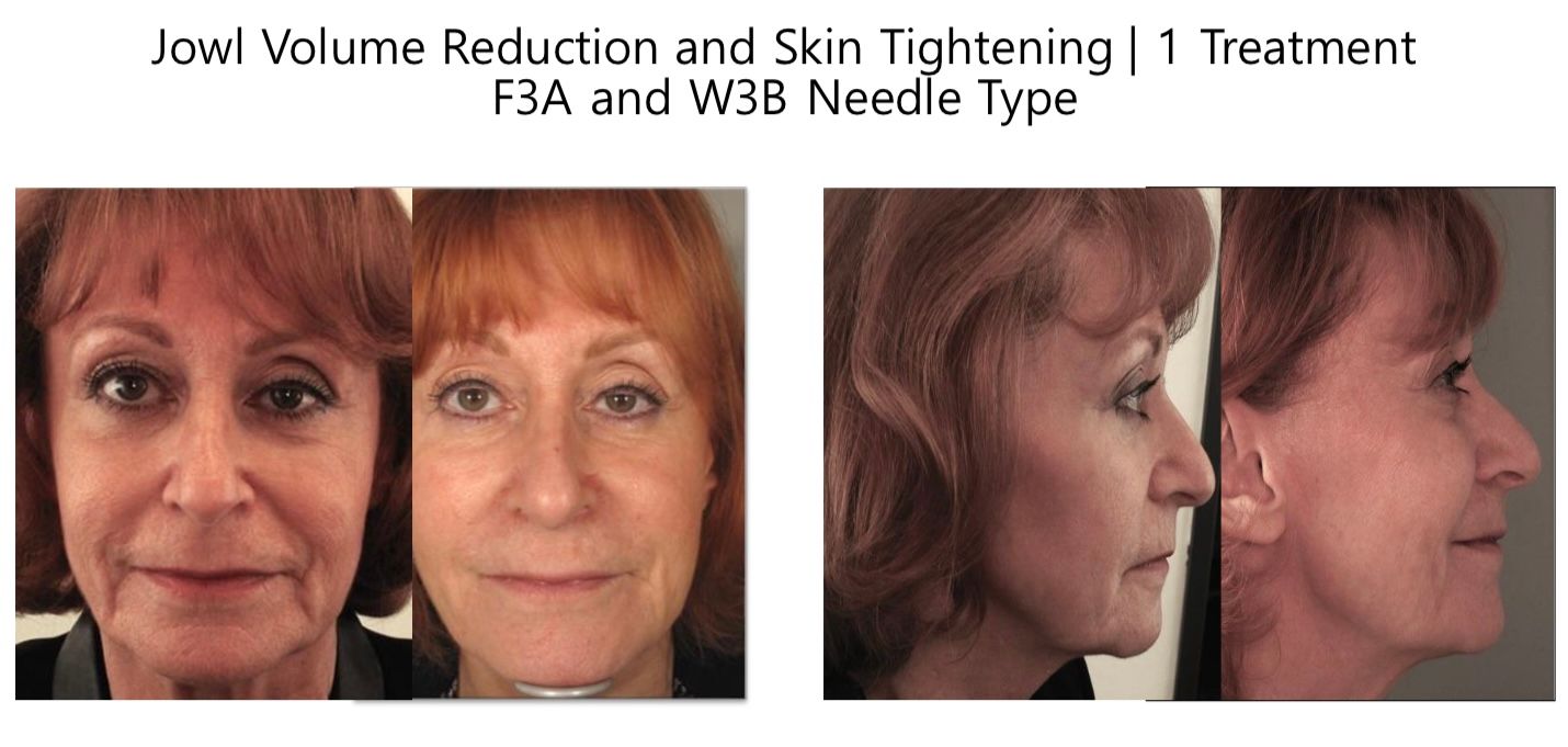 A woman 's face is shown before and after a treatment.