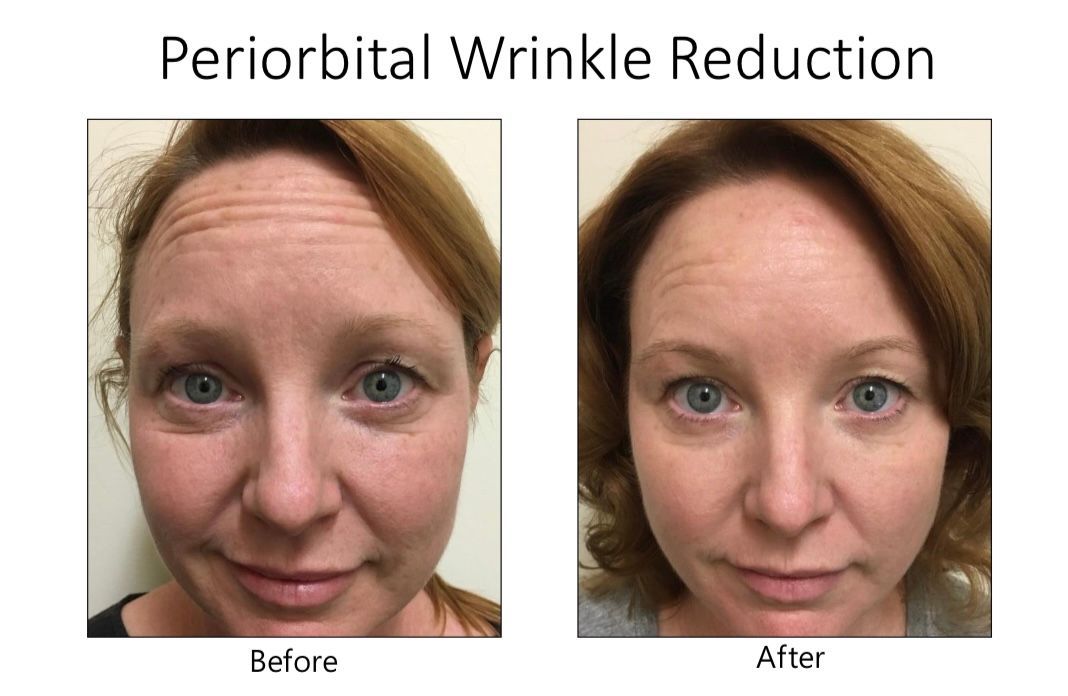 A before and after photo of a woman 's forehead wrinkle reduction.