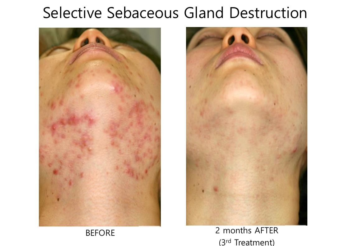 A before and after photo of a woman 's face with acne