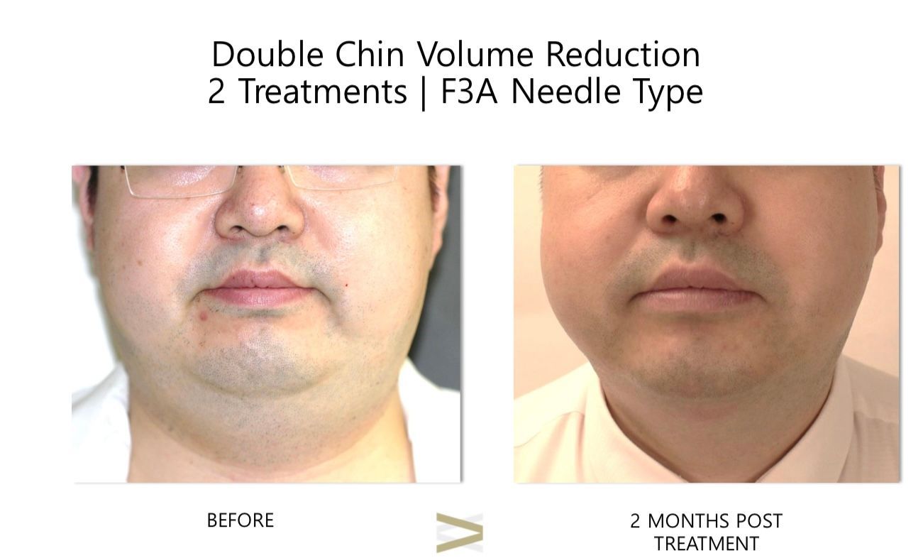 A before and after photo of a man 's face.
