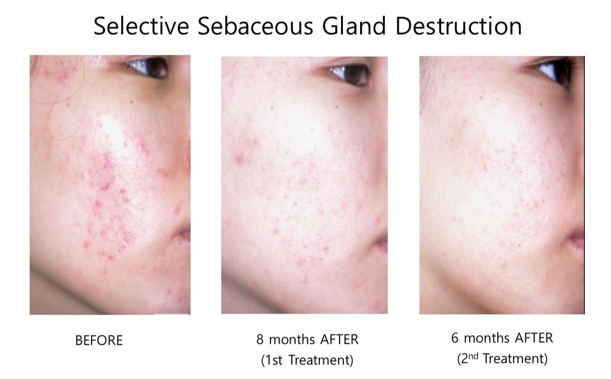 A before and after picture of a woman 's face with acne