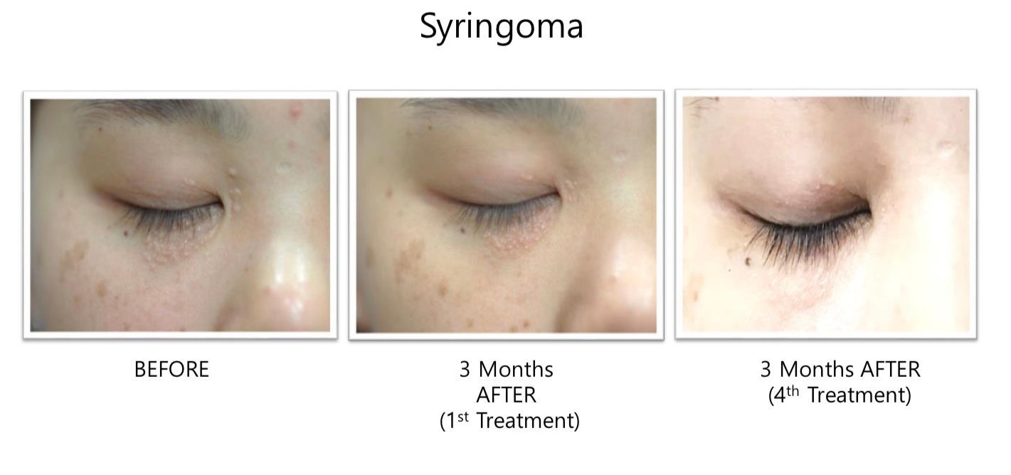 A woman 's face is shown before and after a treatment for syningoma.