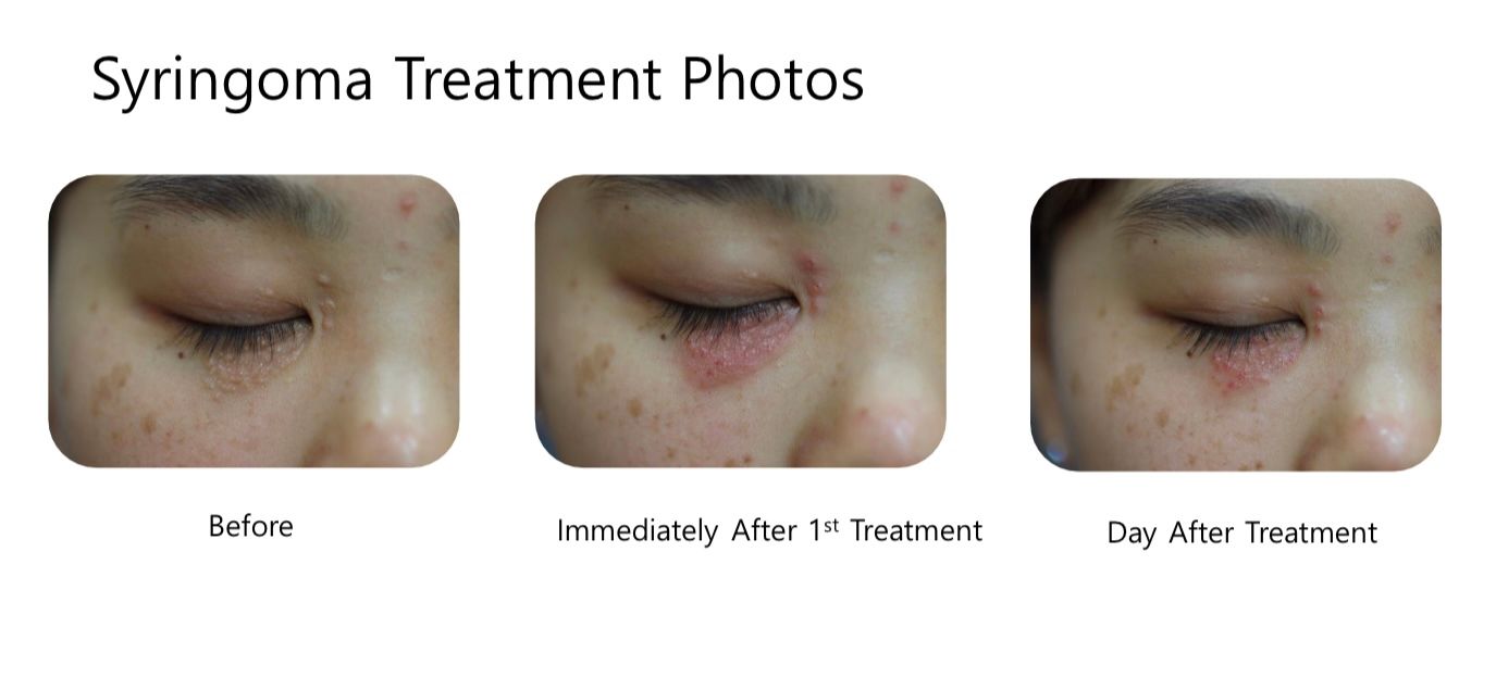 Three pictures of a person 's eye before and after syringoma treatment
