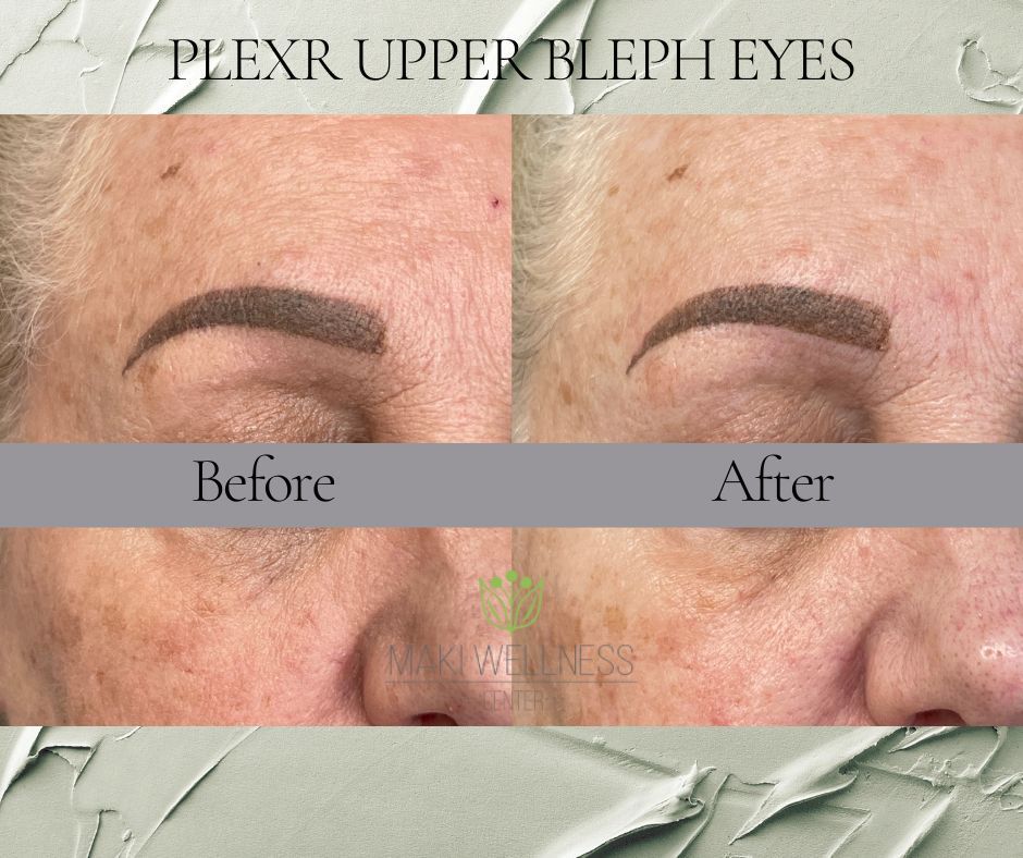 A before and after picture of plexr upper bleph eyes