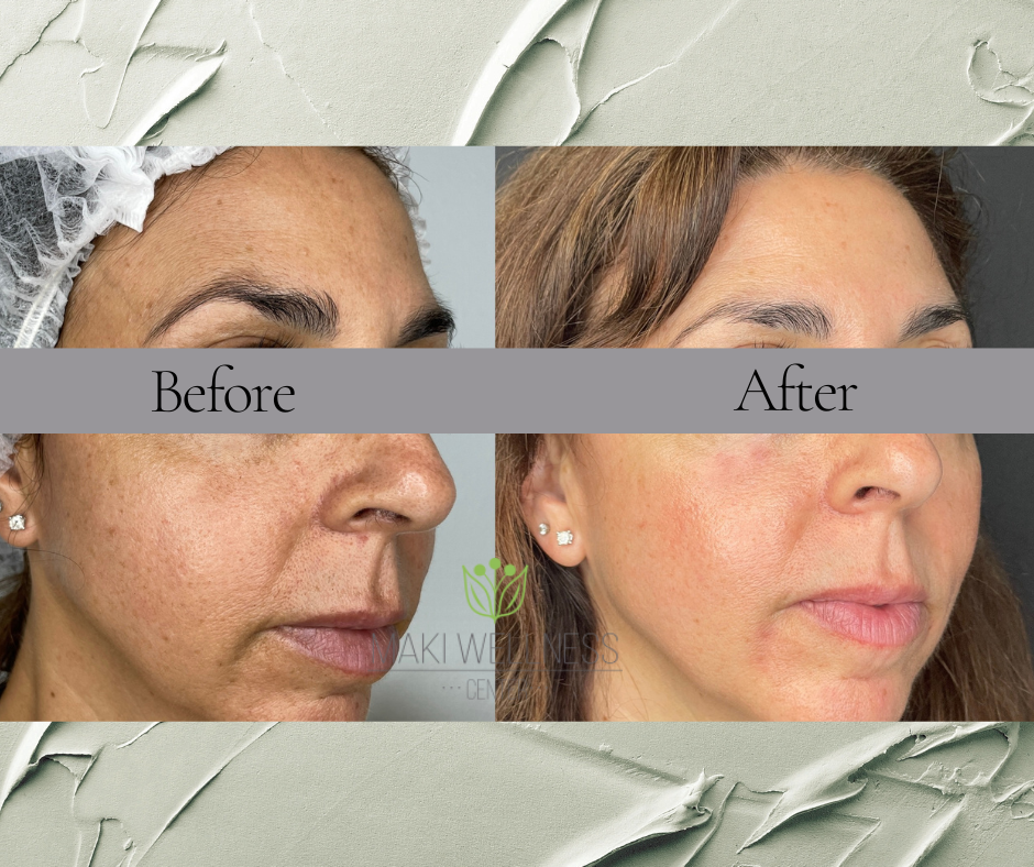 A before and after photo of a woman 's face