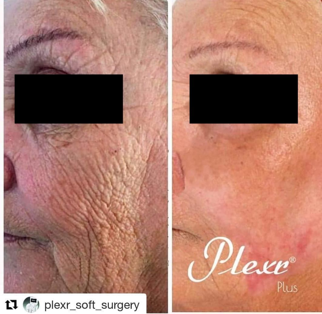 A before and after photo of an older woman 's face