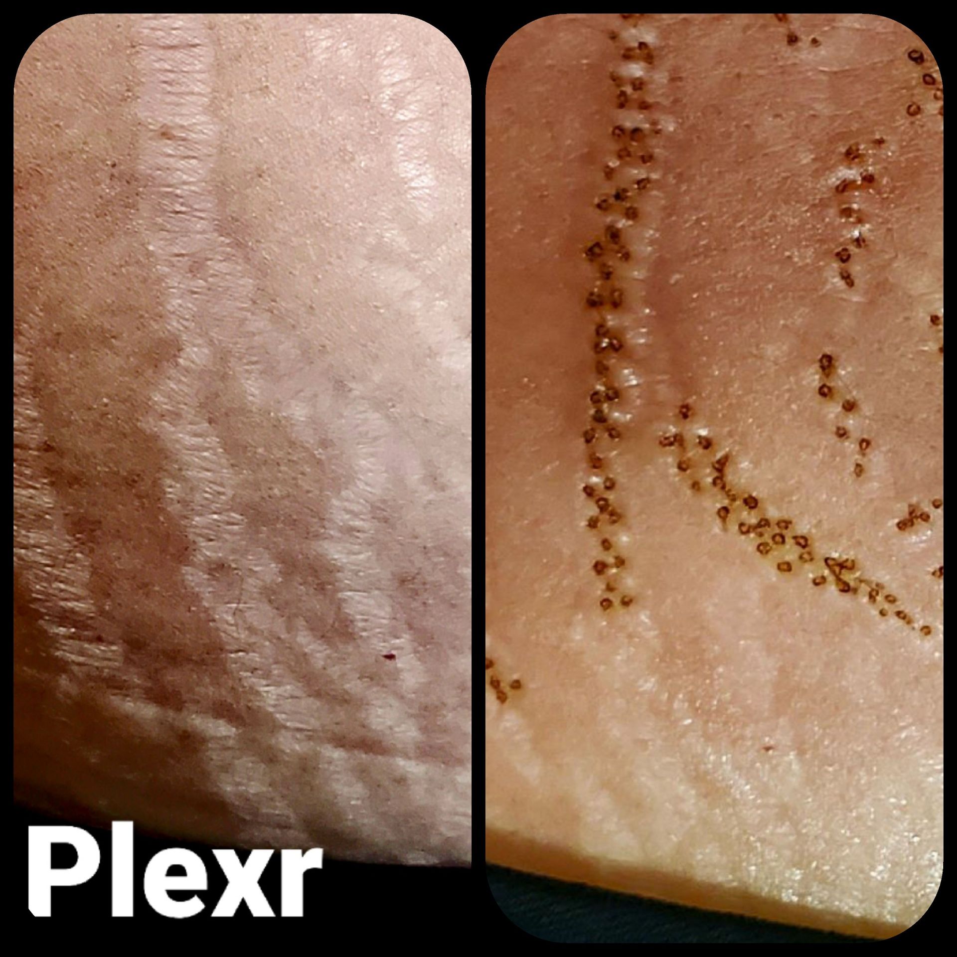 Two pictures of a person 's skin with the word plexr on the bottom