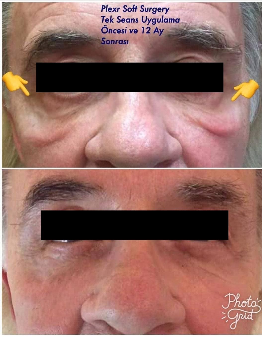 A before and after photo of a man 's face