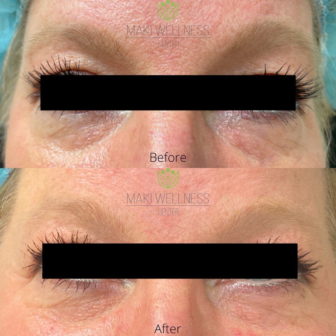 A before and after photo of a woman 's eyes.