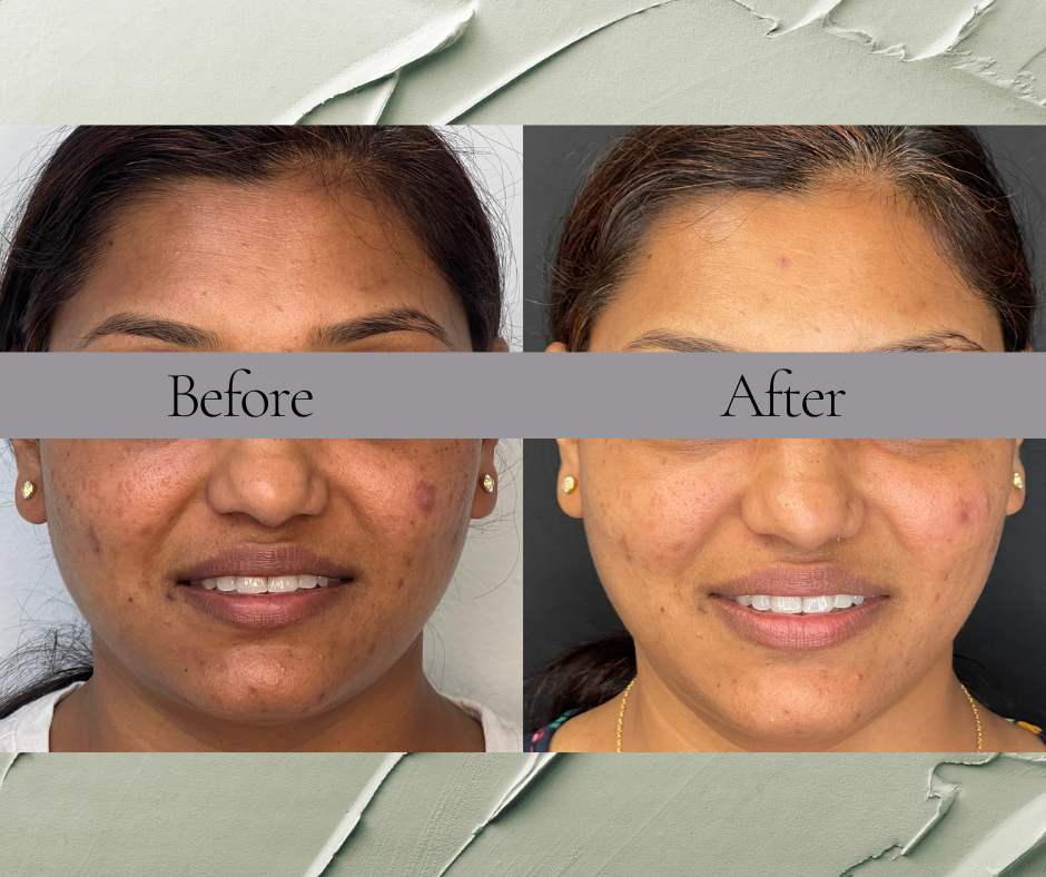 A before and after photo of a woman 's face