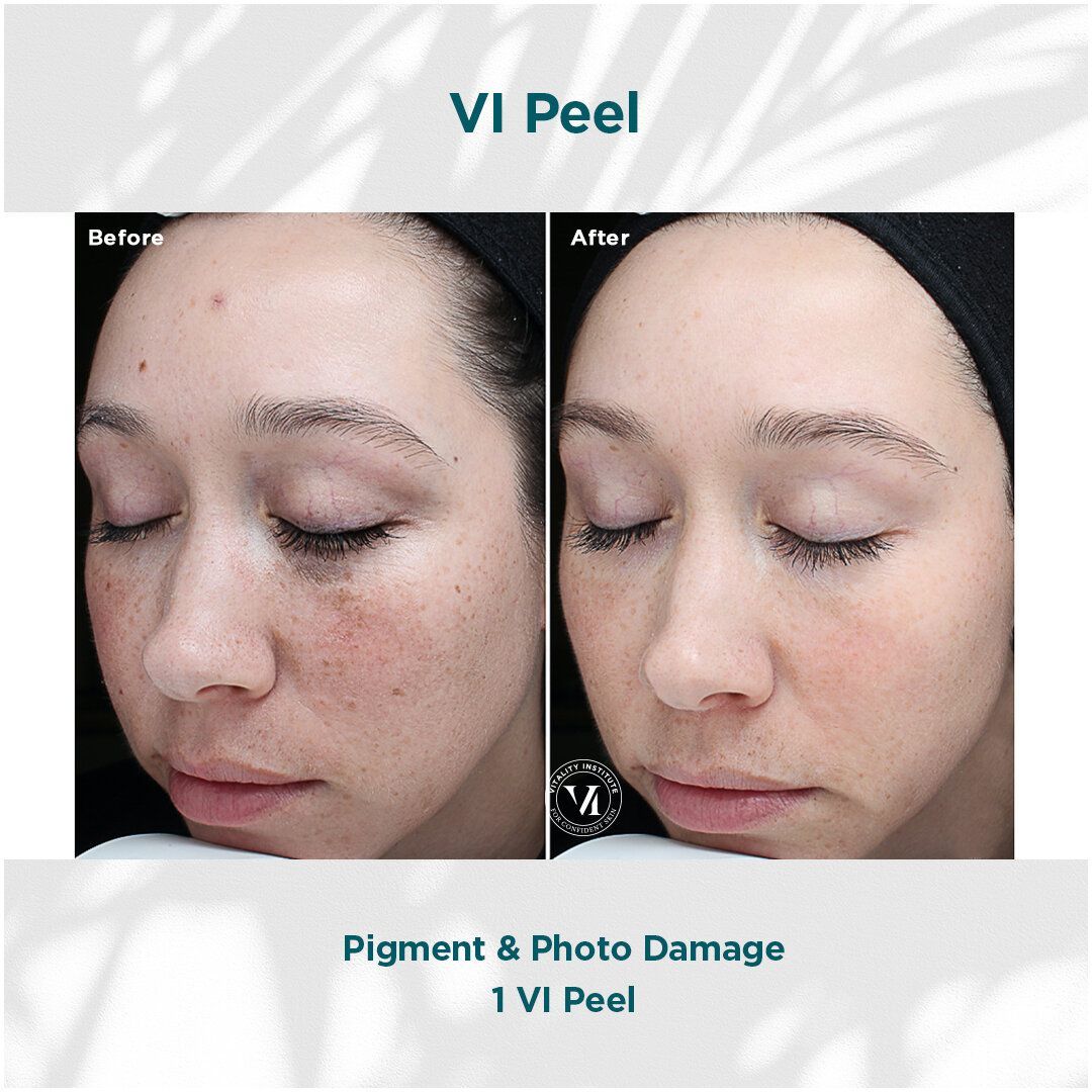 A woman 's face is shown before and after a vi peel