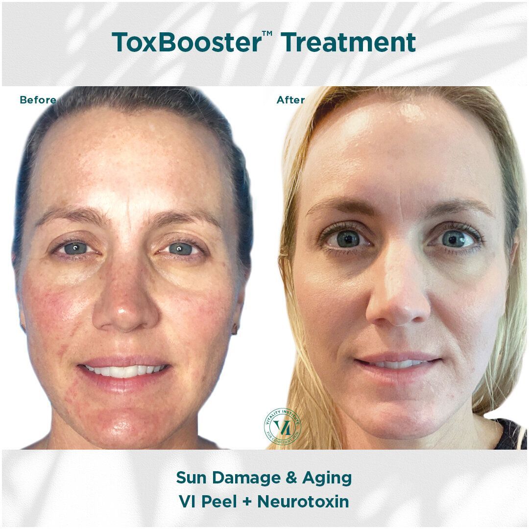A woman 's face before and after a toxbooster treatment