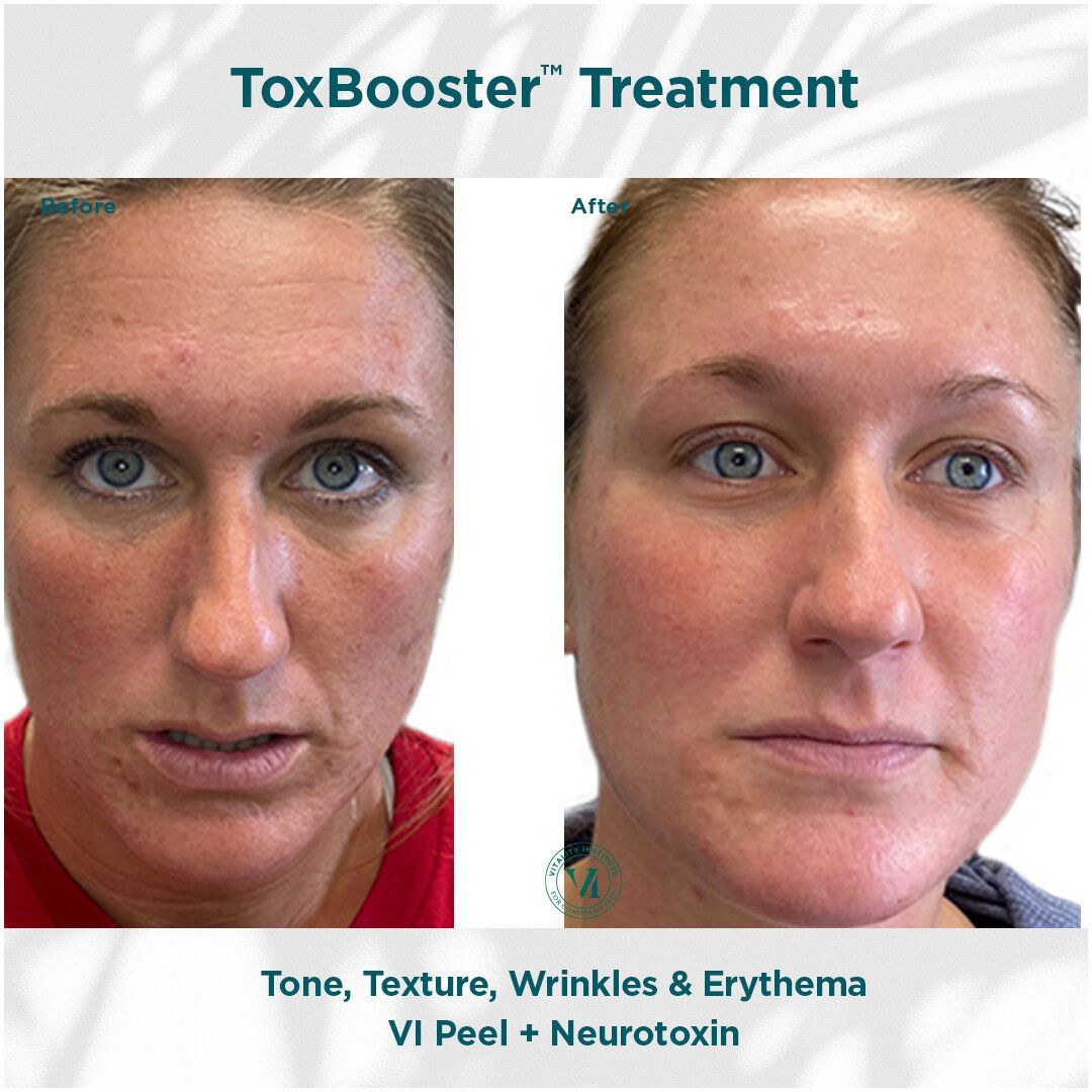 A woman 's face is shown before and after a toxbooster treatment