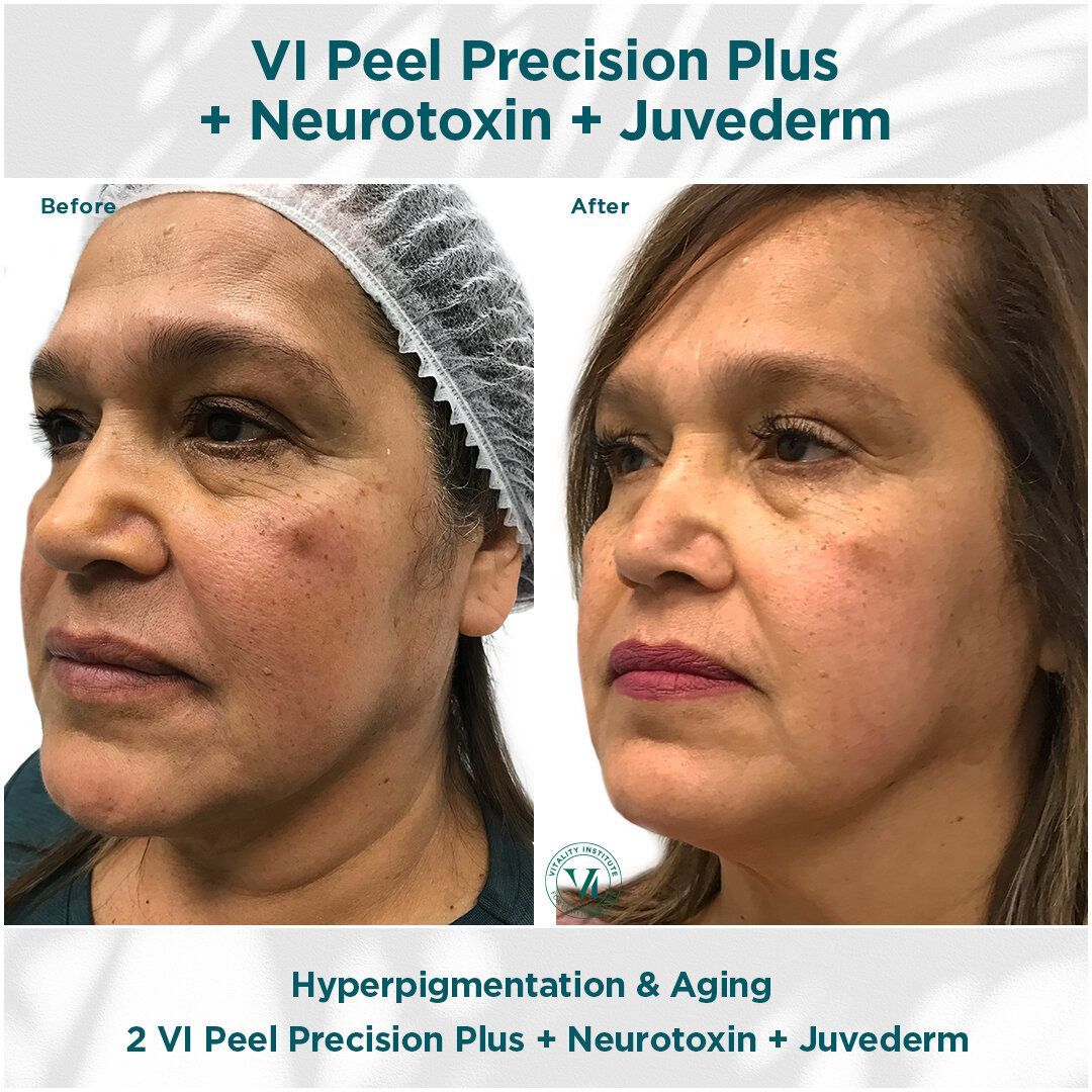 A before and after photo of a woman 's face