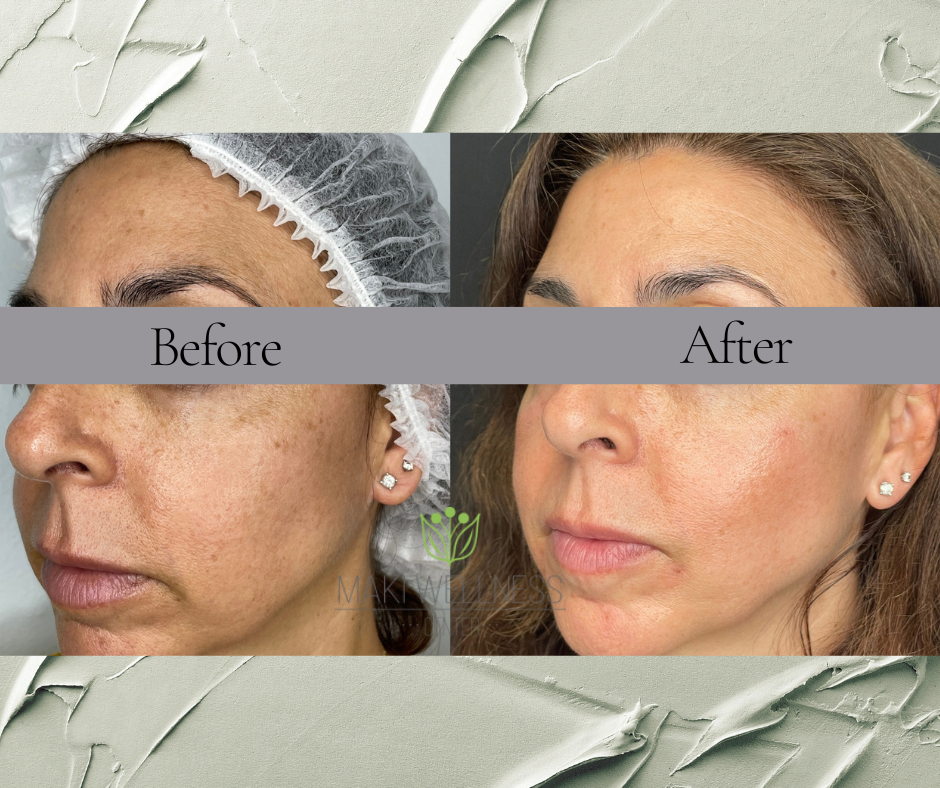 A before and after photo of a woman 's face.