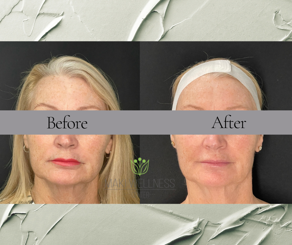 A before and after photo of a woman 's face