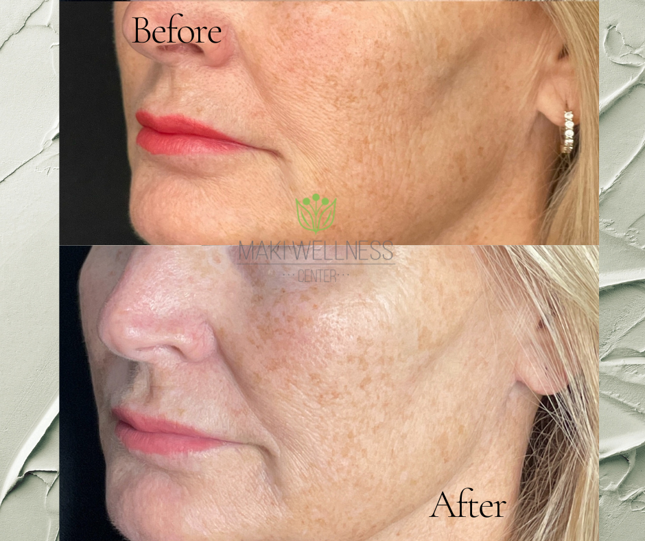 A before and after photo of a woman 's face
