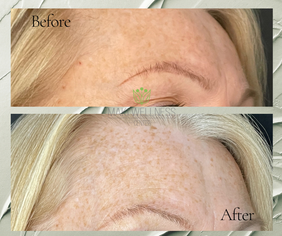 A before and after photo of a woman 's forehead