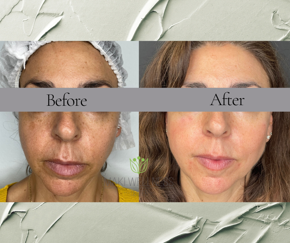 A before and after photo of a woman 's face
