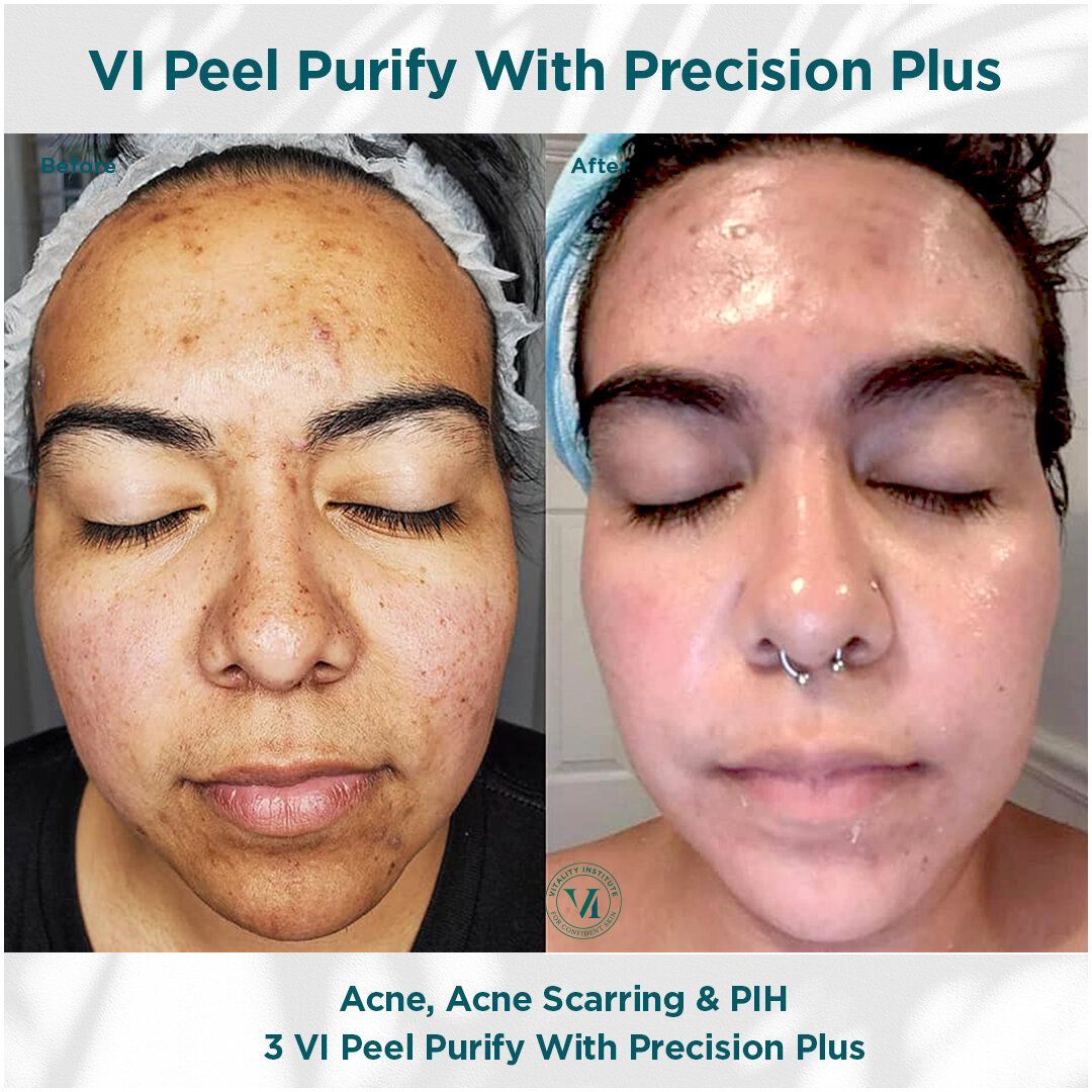 A before and after photo of a woman 's face