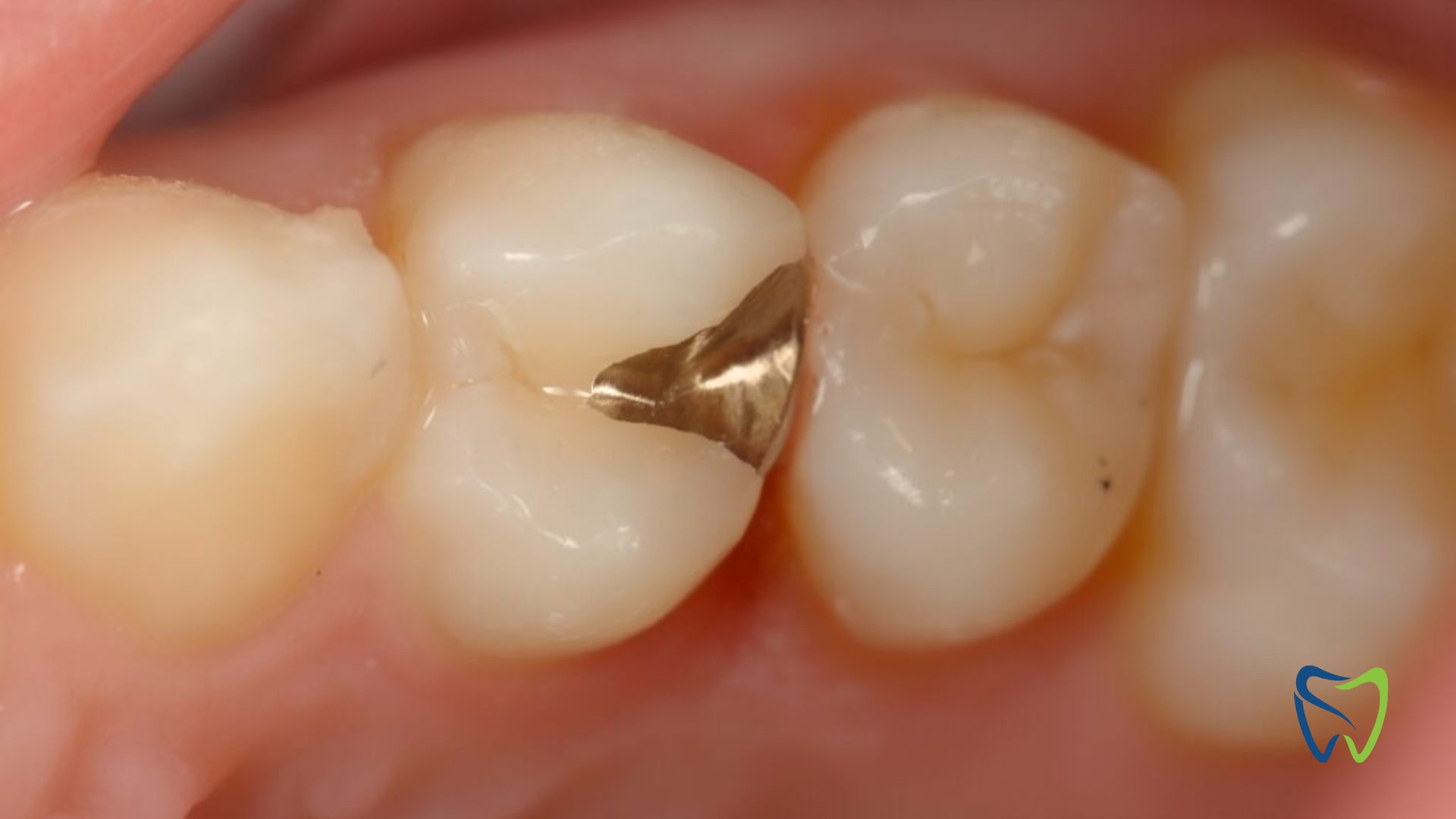 A close up of a tooth with a gold filling in it.