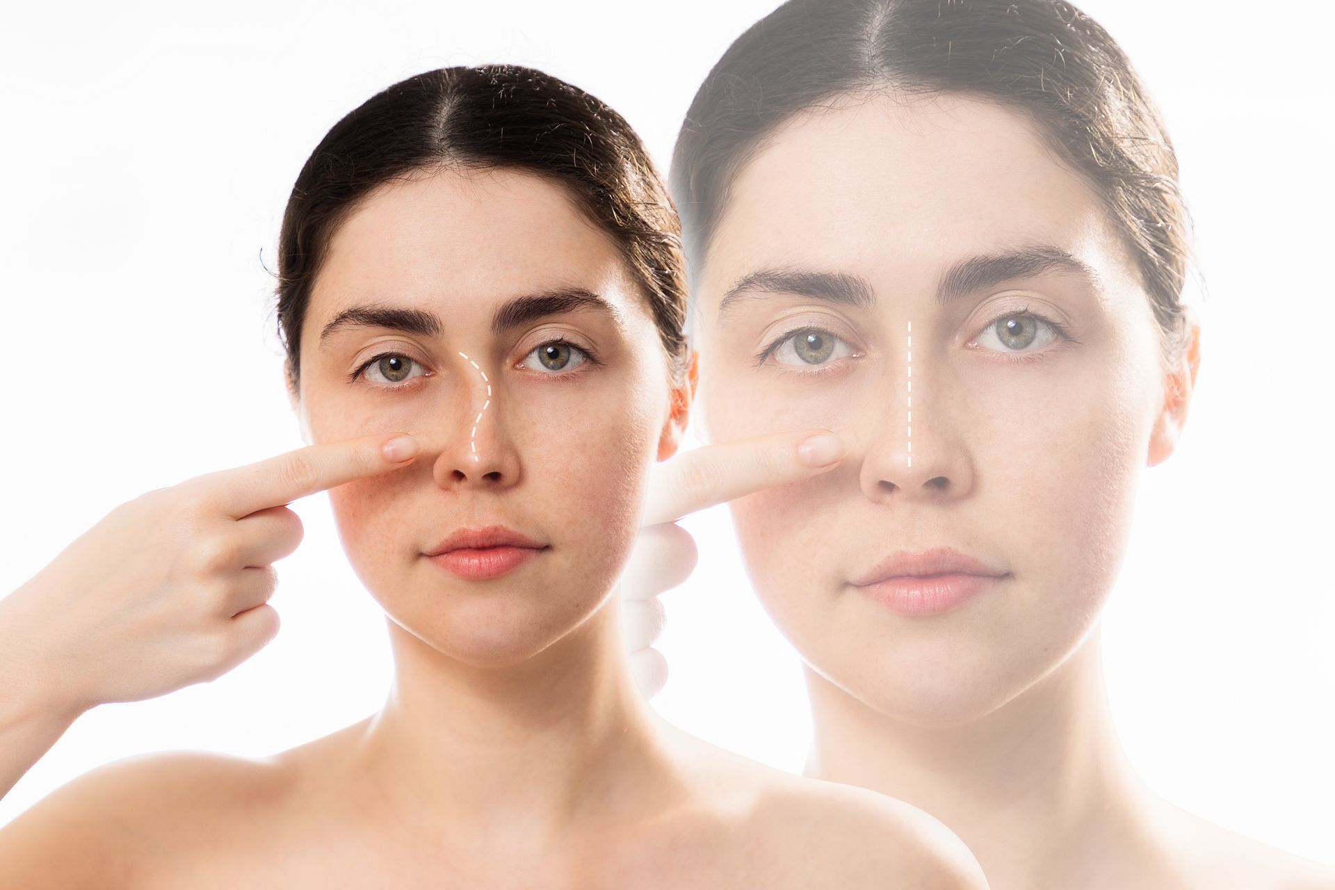 Como saber se preciso de uma rinoplastia secundária? Como saber se preciso de uma rinoplastia secundária?