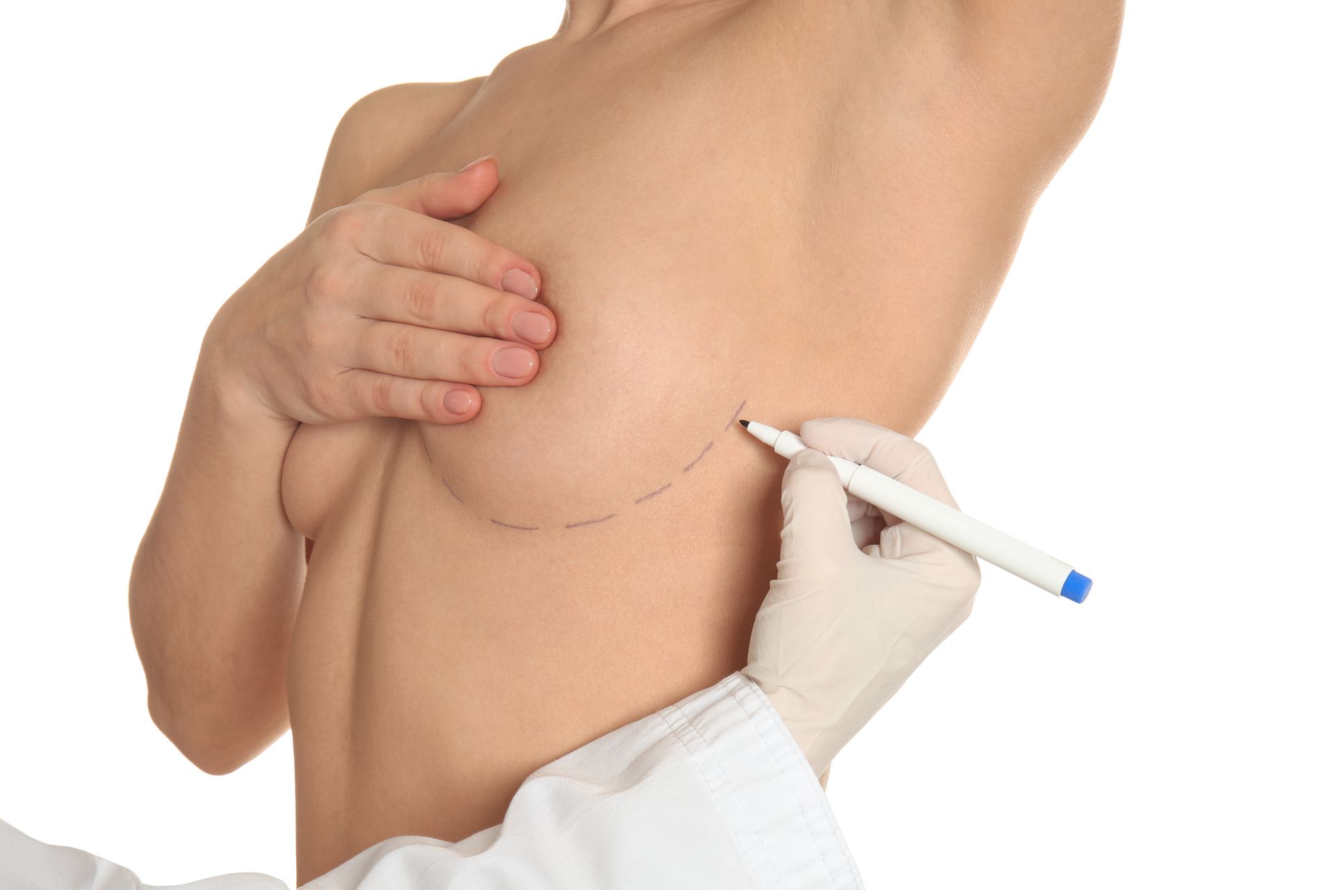 Quais são os tipos de Mastopexia Quais são os tipos de Mastopexia