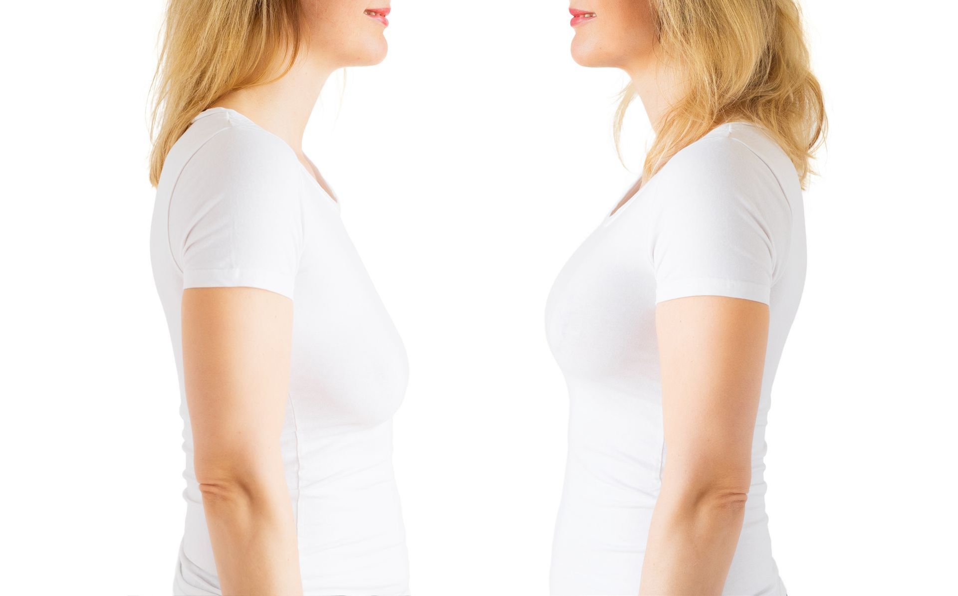 Quanto tempo para se recuperar da mamoplastia redutora Quanto tempo para se recuperar da mamoplastia redutora