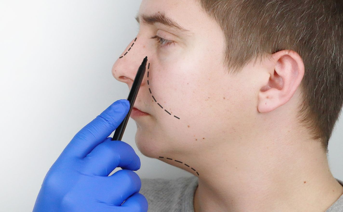 Rinoplastia funcional melhora a respiração Rinoplastia funcional melhora a respiração