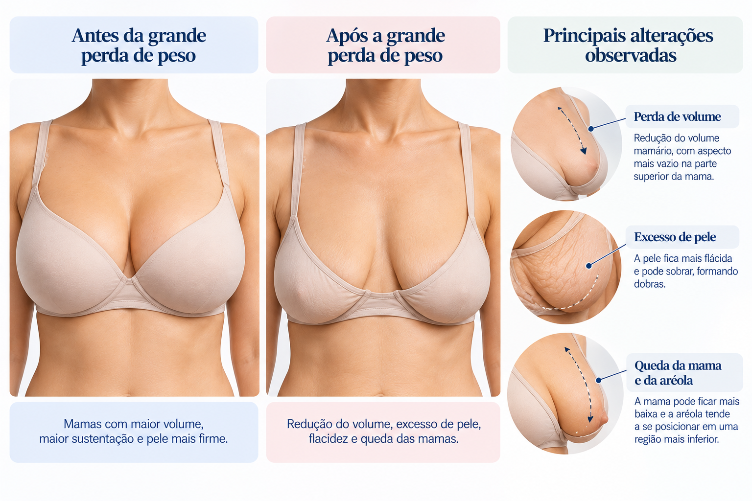 Ilustração das principais alterações das mamas após grande perda de peso, incluindo excesso de pele, perda de volume e queda das mamas.