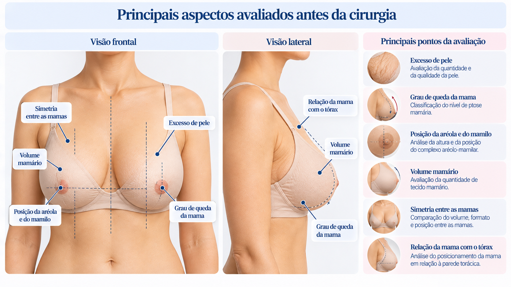 Avaliação pré-operatória das mamas após grande perda de peso, considerando pele, volume, queda, posição da aréola e simetria.