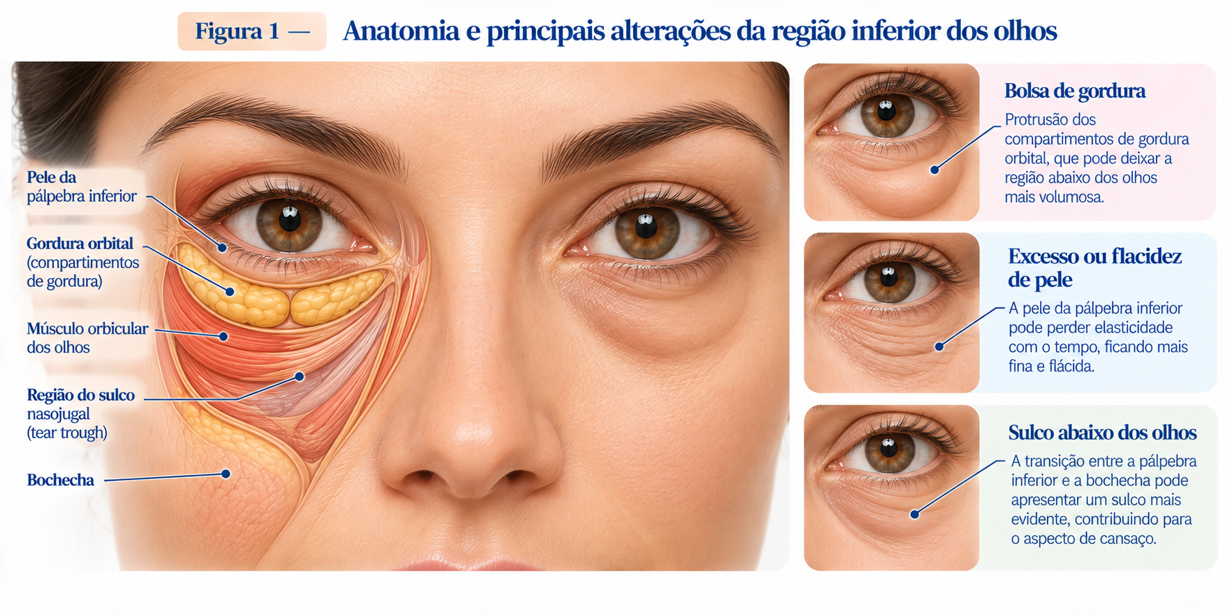 Ilustração da anatomia da pálpebra inferior mostrando gordura orbital, pele, músculo e alterações relacionadas às bolsas abaixo dos olhos.