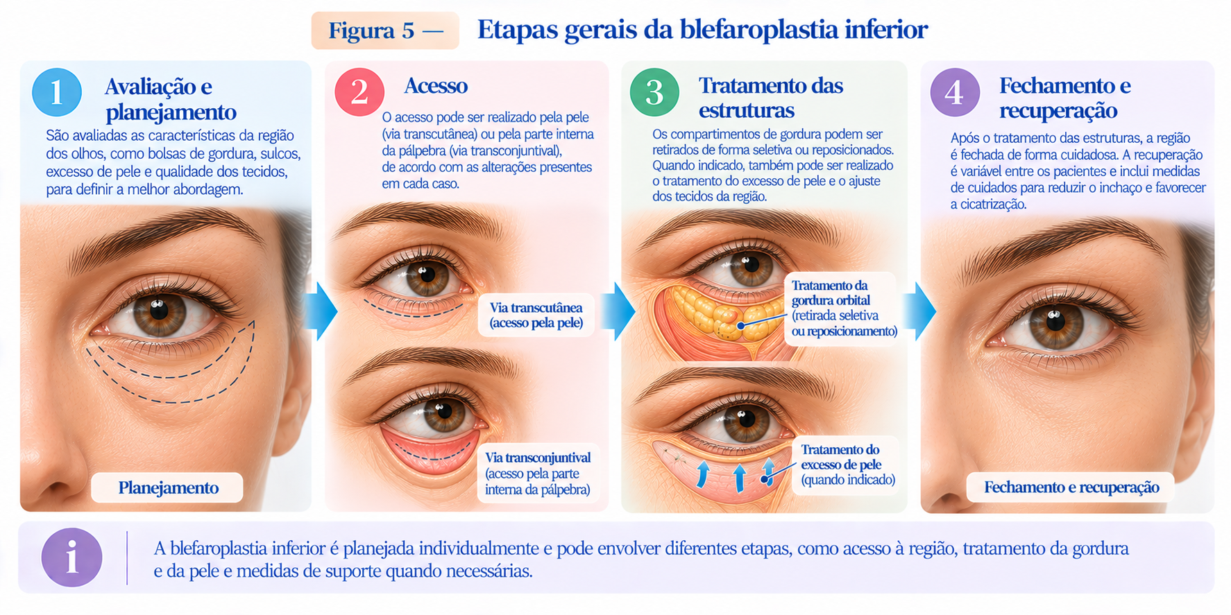 Infográfico mostrando as principais etapas da blefaroplastia inferior, desde o planejamento até o tratamento das estruturas e a recuperação.