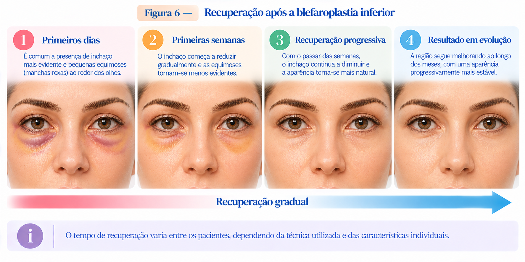 Linha do tempo ilustrada mostrando a redução gradual do inchaço e das equimoses durante a recuperação da blefaroplastia inferior.