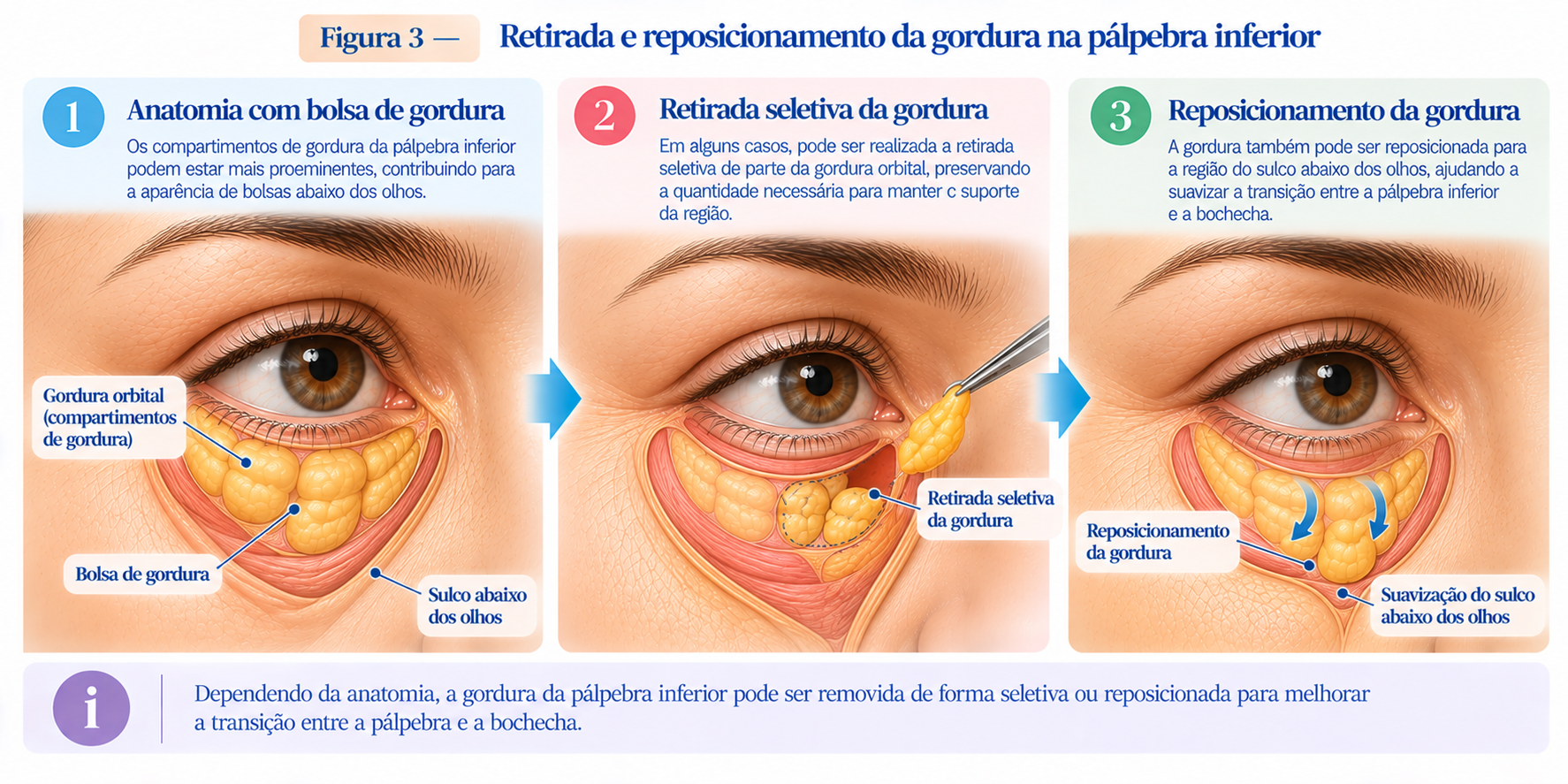 Ilustração mostrando a gordura orbital da pálpebra inferior e a possibilidade de retirada seletiva ou reposicionamento para suavizar o sulco abaixo dos olhos.