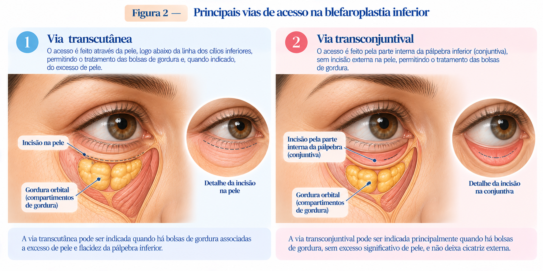 Ilustração comparando as vias transcutânea e transconjuntival utilizadas na blefaroplastia inferior.