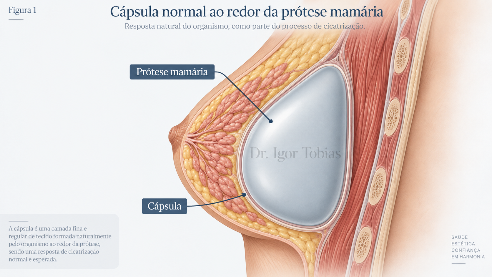 Ilustração mostrando a cápsula normal formada ao redor de uma prótese mamária