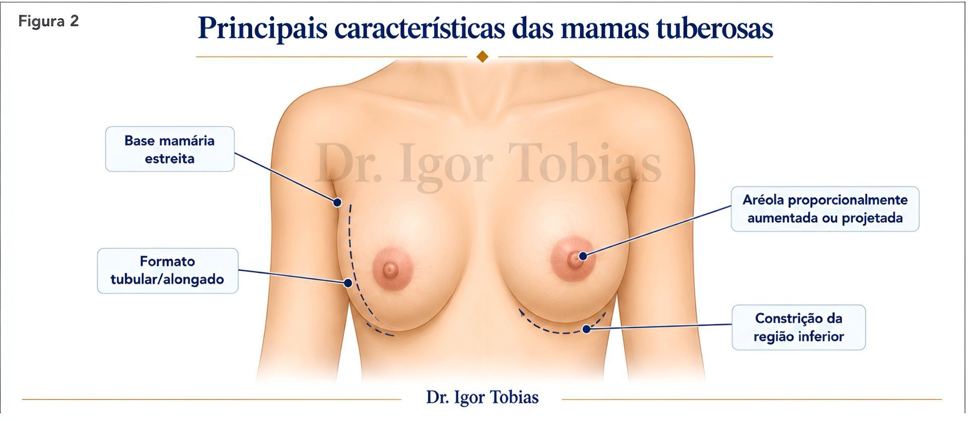 Principais características anatômicas das mamas tuberosas