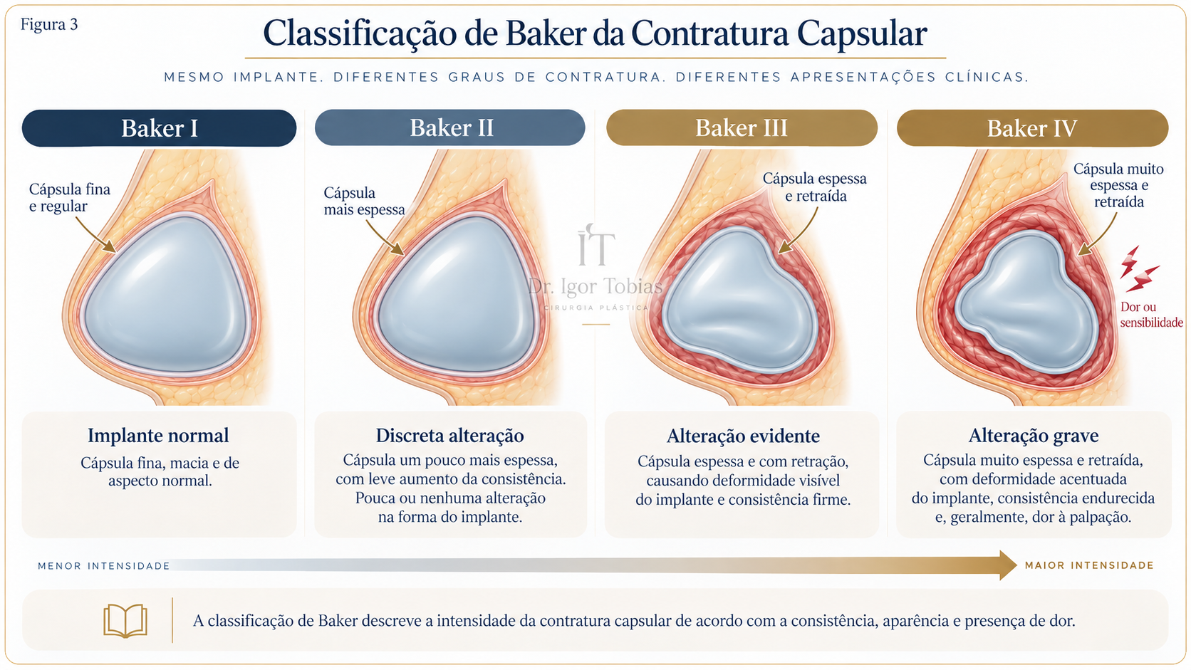 Classificação de Baker dos diferentes graus de contratura capsular em prótese mamária
